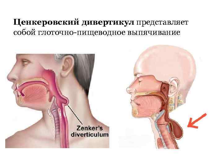 Ценкеровский дивертикул представляет собой глоточно-пищеводное выпячивание 