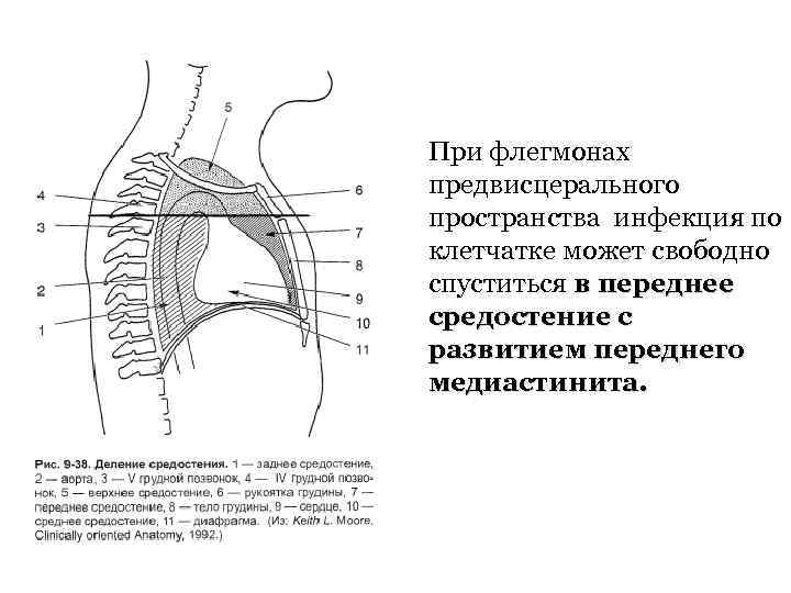 При флегмонах предвисцерального пространства инфекция по клетчатке может свободно спуститься в переднее средостение с