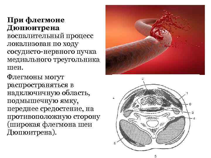 При флегмоне Дюпюитрена воспалительный процесс локализован по ходу сосудисто-нервного пучка медиального треугольника шеи. Флегмоны