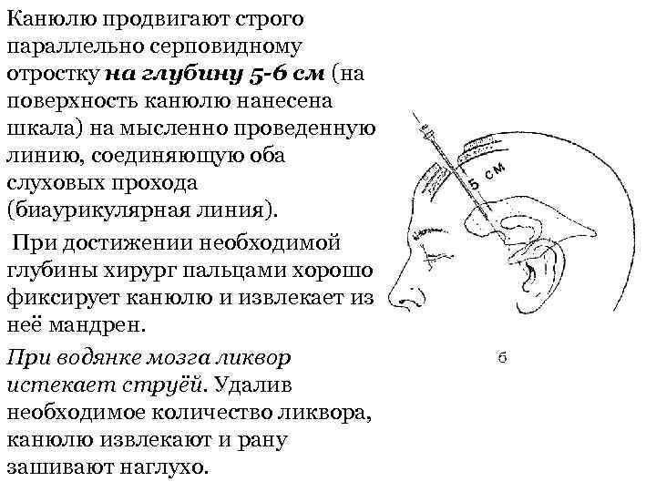 Канюлю продвигают строго параллельно серповидному отростку на глубину 5 -6 см (на поверхность канюлю