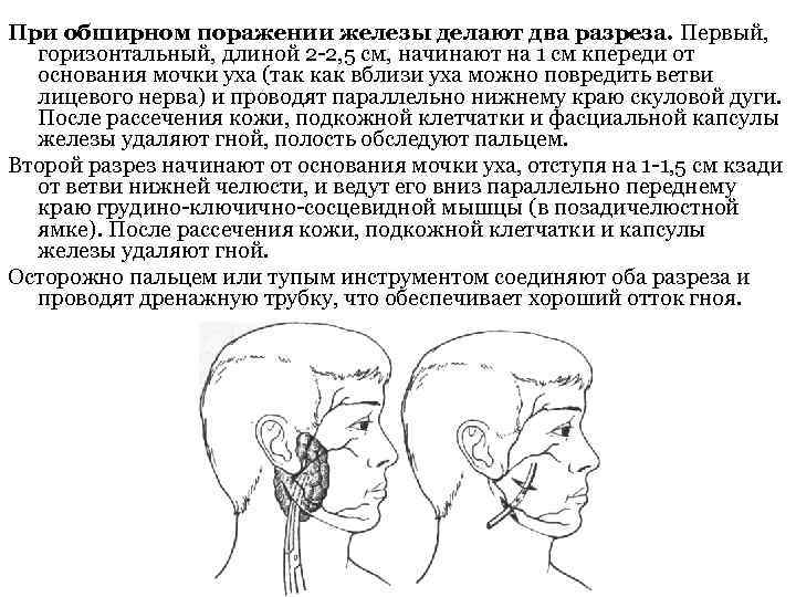 При обширном поражении железы делают два разреза. Первый, горизонтальный, длиной 2 2, 5 см,