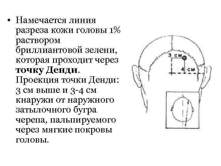  • Намечается линия разреза кожи головы 1% раствором бриллиантовой зелени, которая проходит через