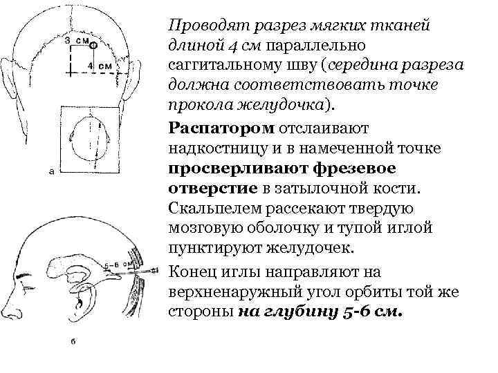 Проводят разрез мягких тканей длиной 4 см параллельно саггитальному шву (середина разреза должна соответствовать