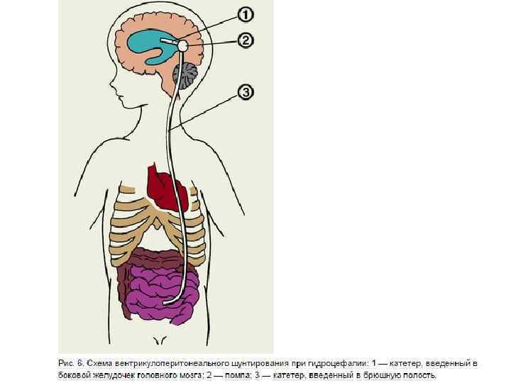 Шунтирование при гидроцефалии головного. Вентрикулоперитонеальный шунт. Вентрикуло-перитонеальное шунтирование головного мозга. Пункция желудочков мозга. Вентрикулоперитонеальный шунт на кт.