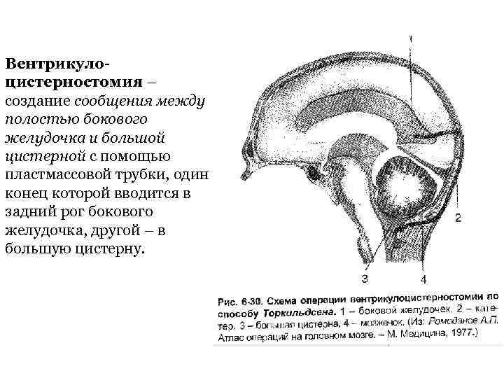 Вентрикулоцистерностомия – создание сообщения между полостью бокового желудочка и большой цистерной с помощью пластмассовой