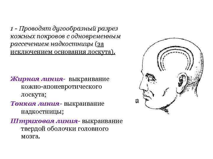 1 - Проводят дугообразный разрез кожных покровов с одновременным рассечением надкостницы (за исключением основания