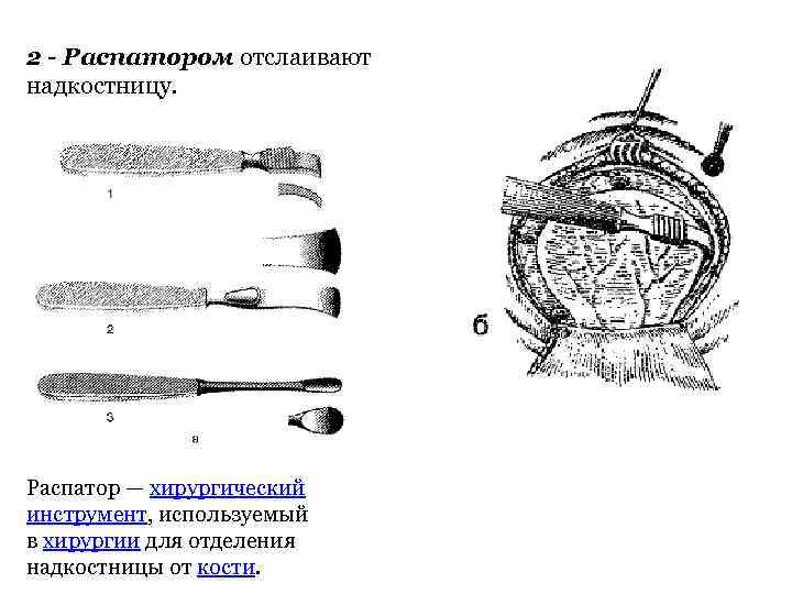 2 - Распатором отслаивают надкостницу. Распатор — хирургический инструмент, используемый в хирургии для отделения