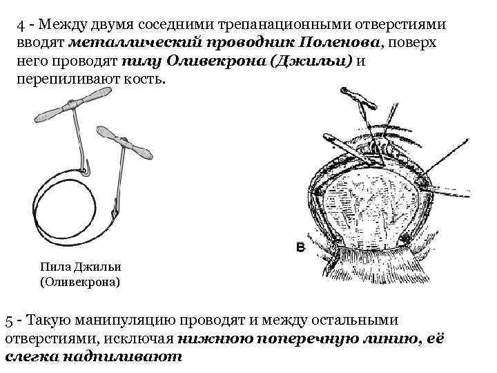 4 Между двумя соседними трепанационными отверстиями вводят металлический проводник Поленова, поверх него проводят пилу