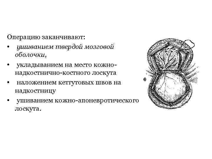 Операцию заканчивают: • ушиванием твердой мозговой оболочки, • укладыванием на место кожно надкостнично костного