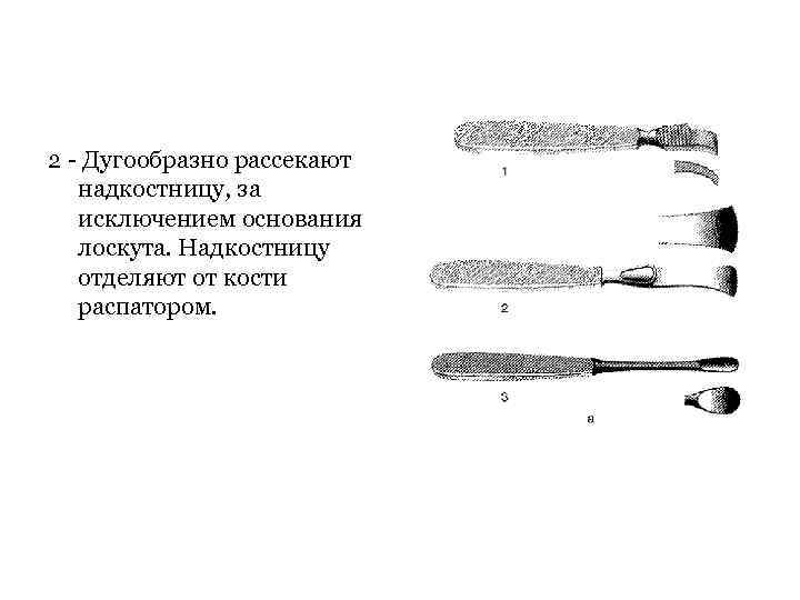 2 Дугообразно рассекают надкостницу, за исключением основания лоскута. Надкостницу отделяют от кости распатором. 