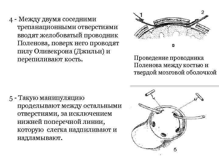 4 Между двумя соседними трепанационными отверстиями вводят желобоватый проводник Поленова, поверх него проводят пилу