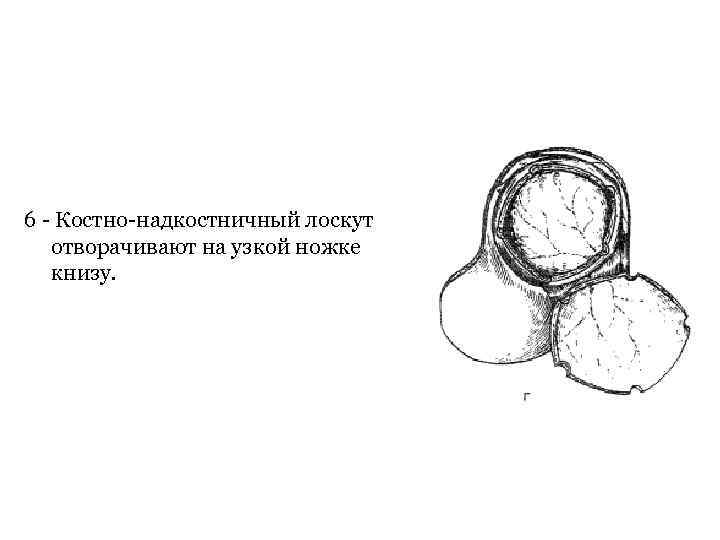 6 Костно надкостничный лоскут отворачивают на узкой ножке книзу. 