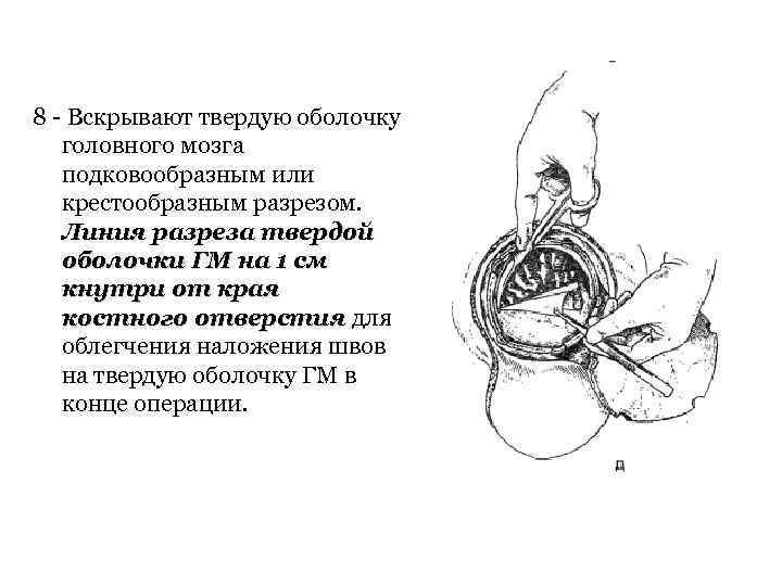 8 Вскрывают твердую оболочку головного мозга подковообразным или крестообразным разрезом. Линия разреза твердой оболочки