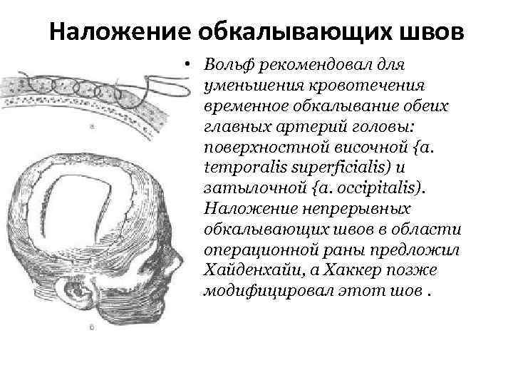 Наложение обкалывающих швов • Вольф рекомендовал для уменьшения кровотечения временное обкалывание обеих главных артерий