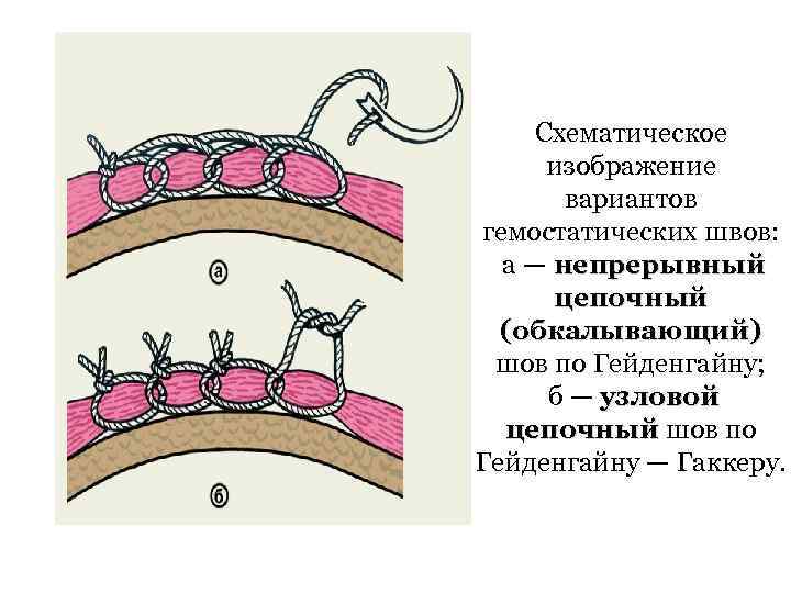 Схематическое изображение вариантов гемостатических швов: а — непрерывный цепочный (обкалывающий) шов по Гейденгайну; б