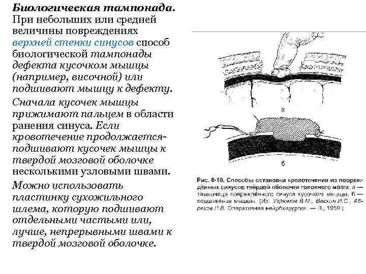 Биологическая тампонада. При небольших или средней величины повреждениях верхней стенки синусов способ биологической тампонады