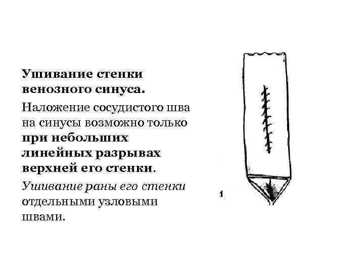 Ушивание стенки венозного синуса. Наложение сосудистого шва на синусы возможно только при небольших линейных