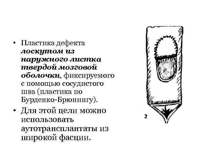  • Пластика дефекта лоскутом из наружного листка твердой мозговой оболочки, фиксируемого оболочки с