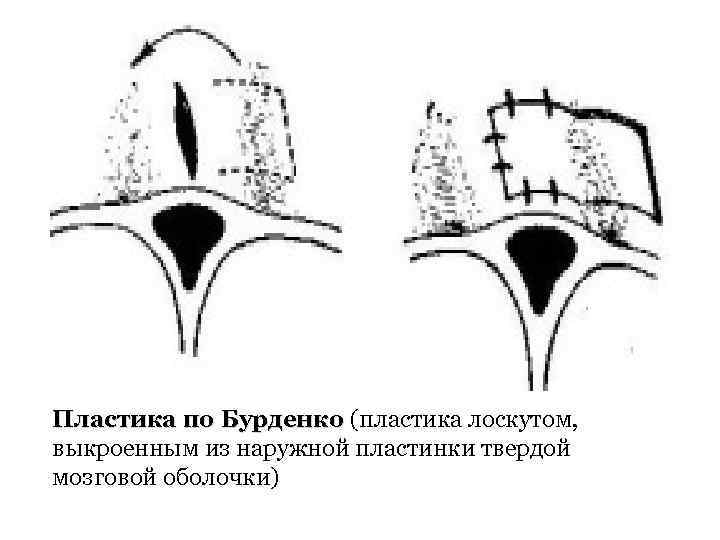 Пластика по Бурденко (пластика лоскутом, выкроенным из наружной пластинки твердой мозговой оболочки) 