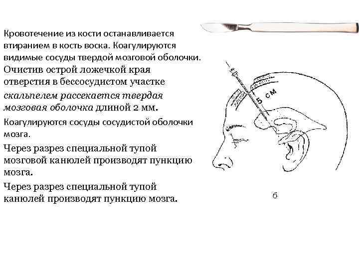 Кровотечение из кости останавливается втиранием в кость воска. Коагулируются видимые сосуды твердой мозговой оболочки.