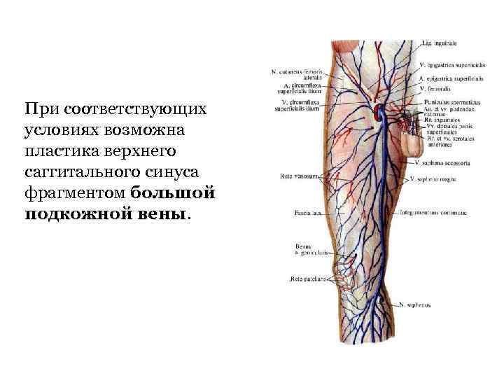 При соответствующих условиях возможна пластика верхнего саггитального синуса фрагментом большой подкожной вены 