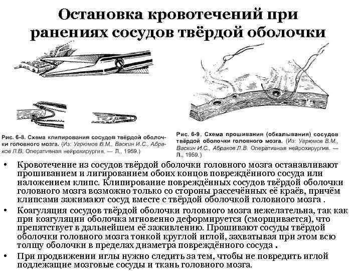 Остановка кровотечений при ранениях сосудов твёрдой оболочки • • • Кровотечение из сосудов твёрдой