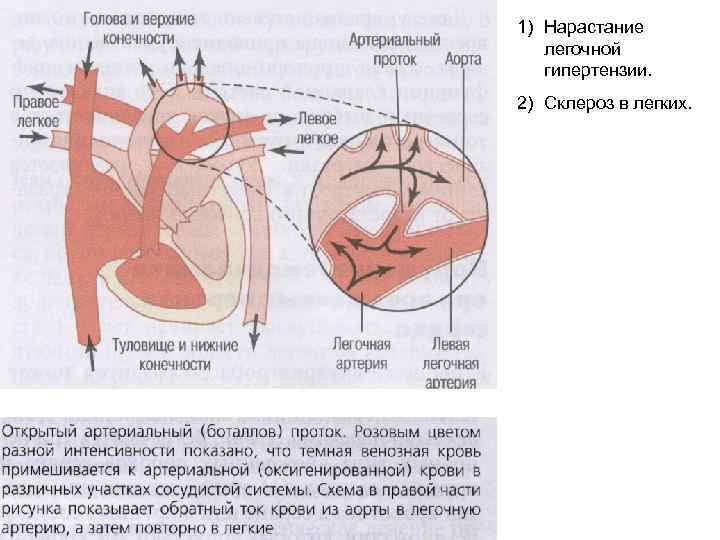 1) Нарастание легочной гипертензии. 2) Склероз в легких. 