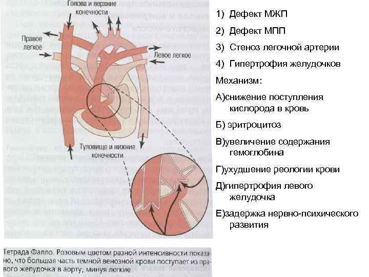 Уплотнение стенок аорты. Гипертрофия базального отдела МЖП. Базальный отдел межжелудочковой перегородки. Миокард межжелудочковой перегородки. Гипертрофия межжелудочковой перегородки.