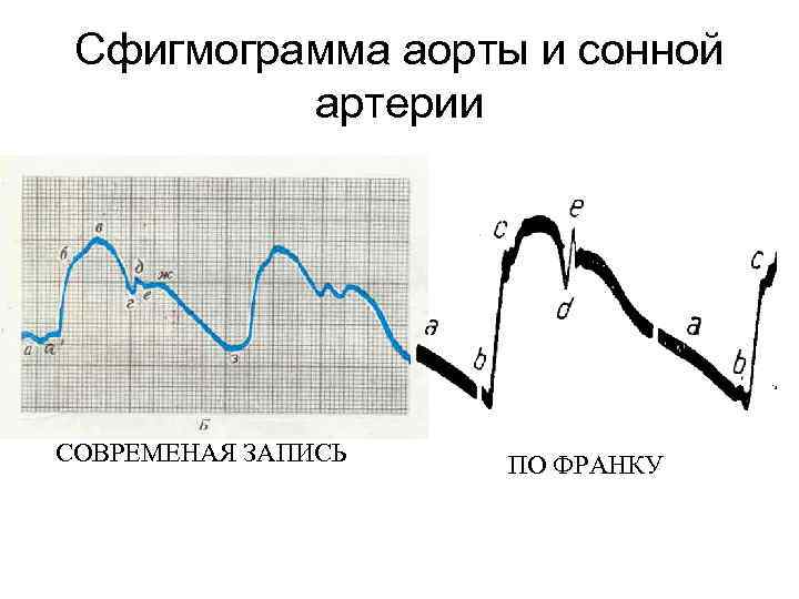 Сфигмограмма аорты и сонной артерии СОВРЕМЕНАЯ ЗАПИСЬ ПО ФРАНКУ 