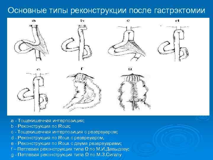 Основные типы реконструкции после гастрэктомии a - Тощекишечная интерпозиция; b - Реконструкция по Roux;