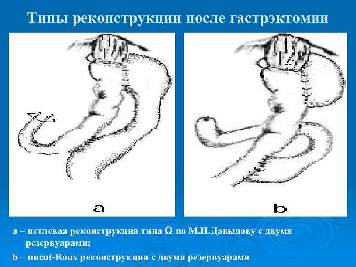 Типы реконструкции после гастрэктомии а – петлевая реконструкция типа Ω по М. И. Давыдову