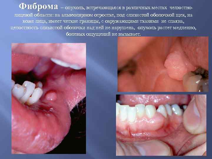 Фиброма – опухоль, встречающаяся в различных местах челюстнолицевой области: на альвеолярном отростке, под слизистой