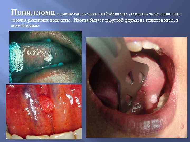 Папиллома встречается на слизистой оболочке , опухоль чаще имеет вид сосочка различной величины. Иногда