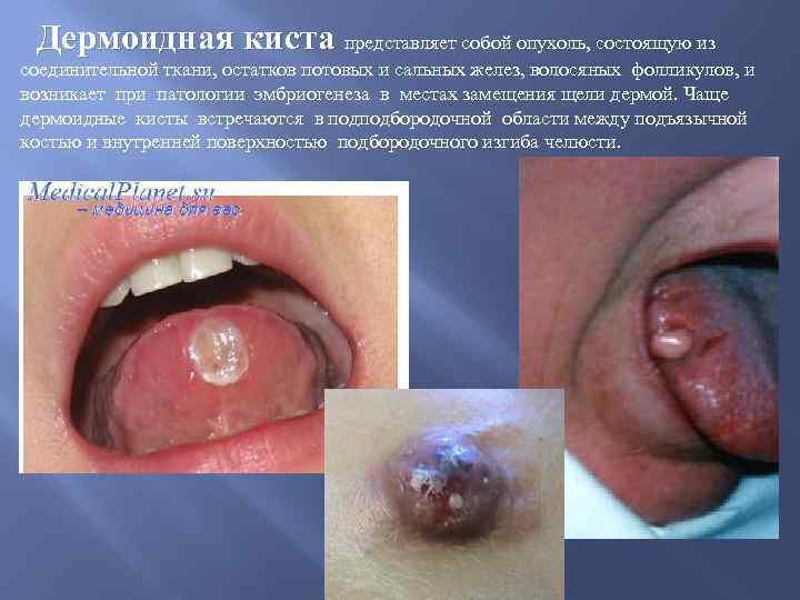 Дермоидная киста представляет собой опухоль, состоящую из соединительной ткани, остатков потовых и сальных желез,