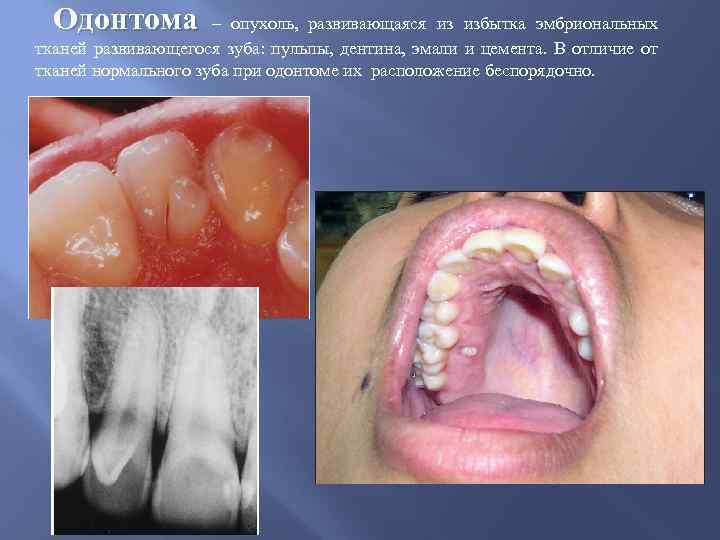 Одонтома – опухоль, развивающаяся из избытка эмбриональных тканей развивающегося зуба: пульпы, дентина, эмали и