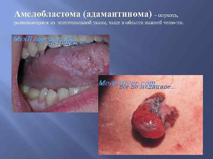 Амелобластома (адамантинома) – опухоль, развивающаяся из эпителиальной ткани, чаще в области нижней челюсти. 