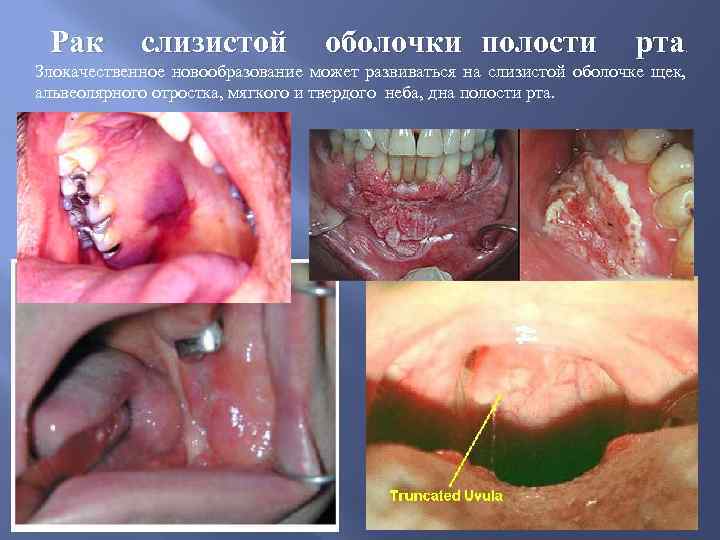 Рак слизистой оболочки полости рта . Злокачественное новообразование может развиваться на слизистой оболочке щек,