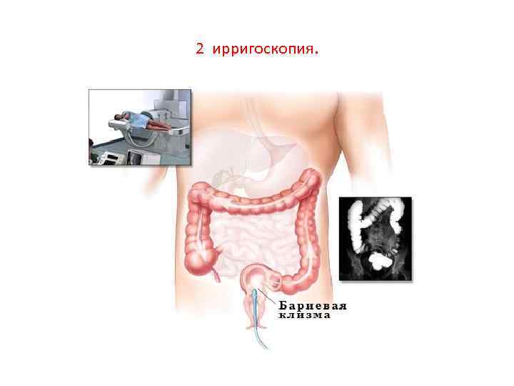 2 ирригоскопия. 