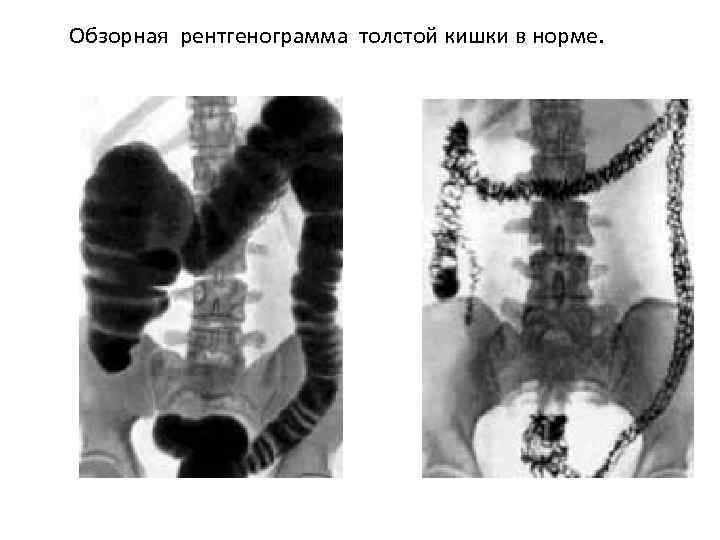Обзорная рентгенограмма толстой кишки в норме. 
