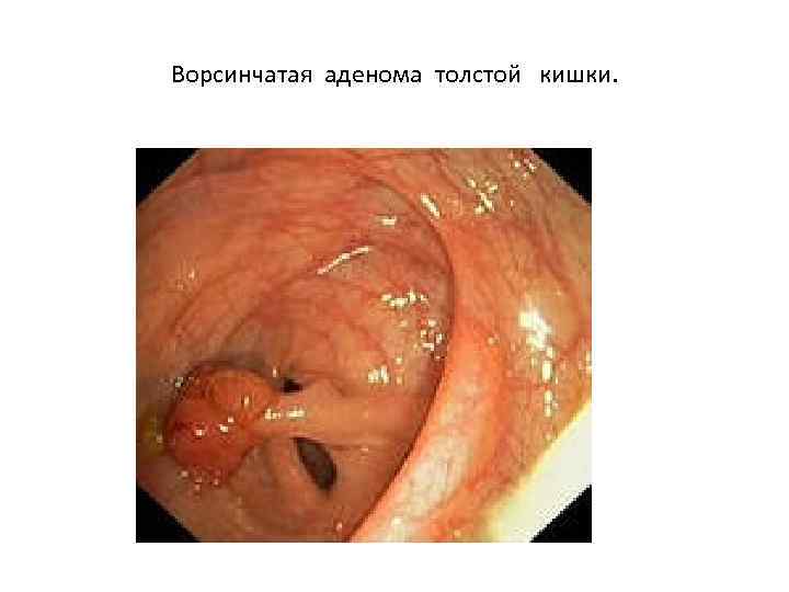 Ворсинчатая аденома толстой кишки. 