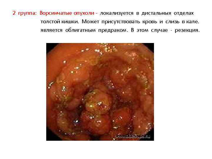 2 группа: Ворсинчатые опухоли - локализуется в дистальных отделах толстой кишки. Может присутствовать кровь