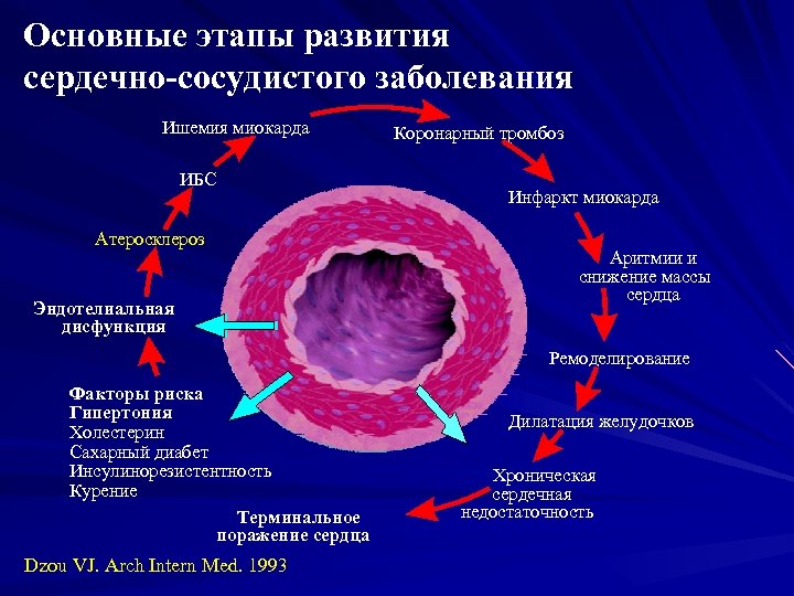 Основные этапы развития сердечно-сосудистого заболевания Ишемия миокарда ИБС Атеросклероз Эндотелиальная дисфункция Коронарный тромбоз Инфаркт
