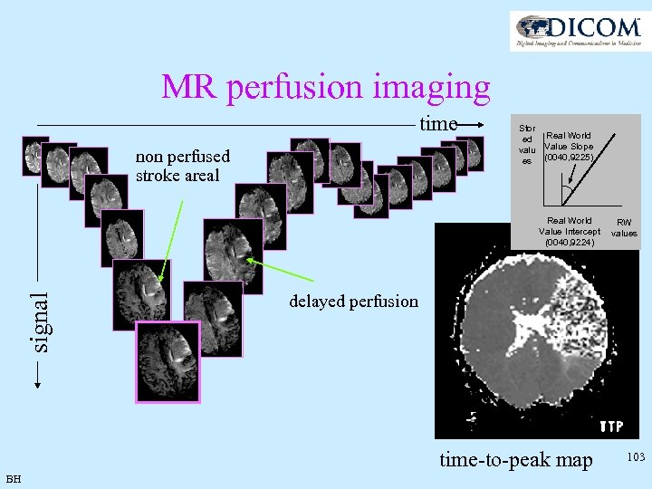 MR perfusion imaging time non perfused stroke areal Stor ed valu es Real World