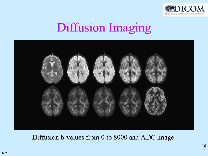 Diffusion Imaging Diffusion b-values from 0 to 8000 and ADC image 16 KV 