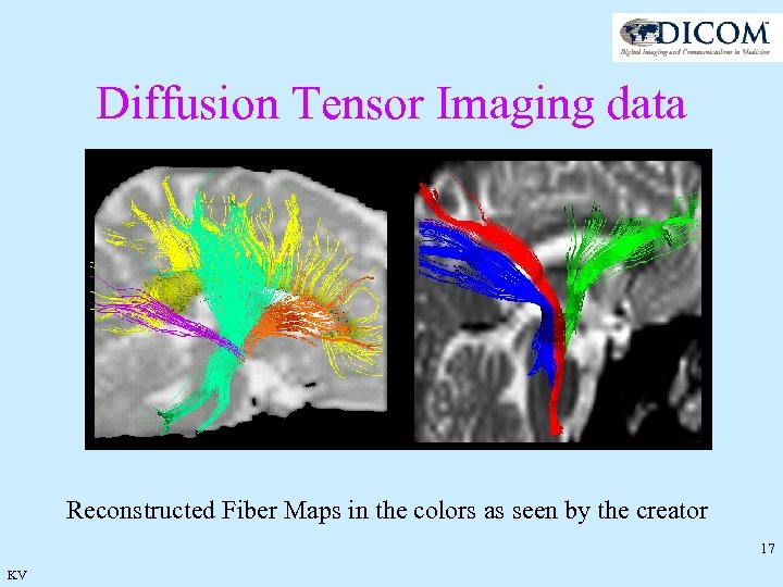 Diffusion Tensor Imaging data Reconstructed Fiber Maps in the colors as seen by the