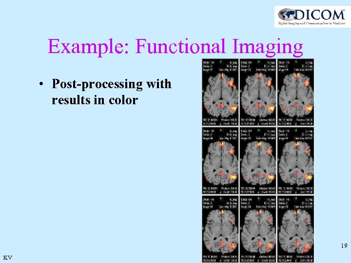 Example: Functional Imaging • Post-processing with results in color 19 KV 