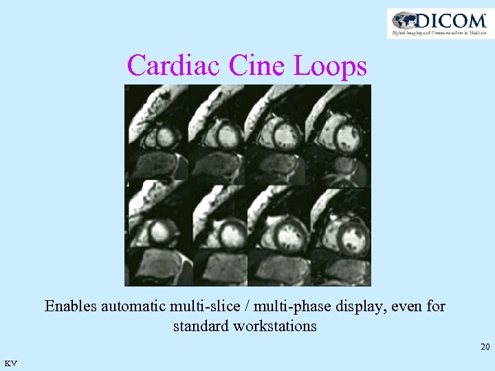 Cardiac Cine Loops Enables automatic multi-slice / multi-phase display, even for standard workstations 20