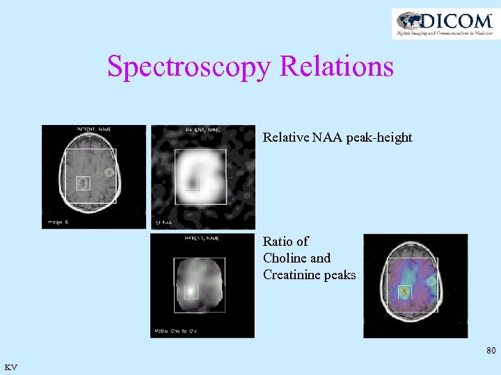 Spectroscopy Relations Relative NAA peak-height Ratio of Choline and Creatinine peaks 80 KV 