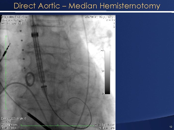 Direct Aortic – Median Hemisternotomy 12 