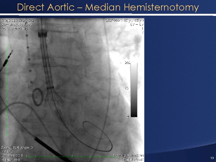 Direct Aortic – Median Hemisternotomy 13 